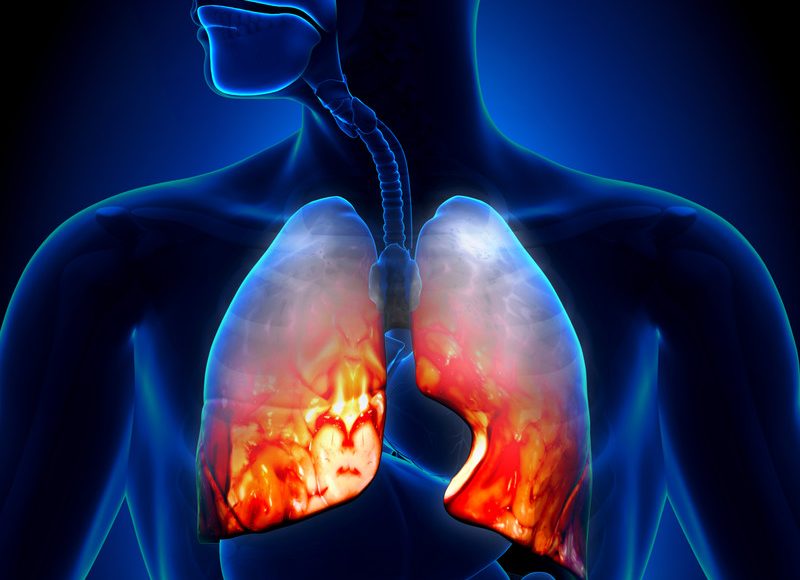 What Is Walking Pneumonia? [Signs, Symptoms, Causes, Treatment, FAQ]