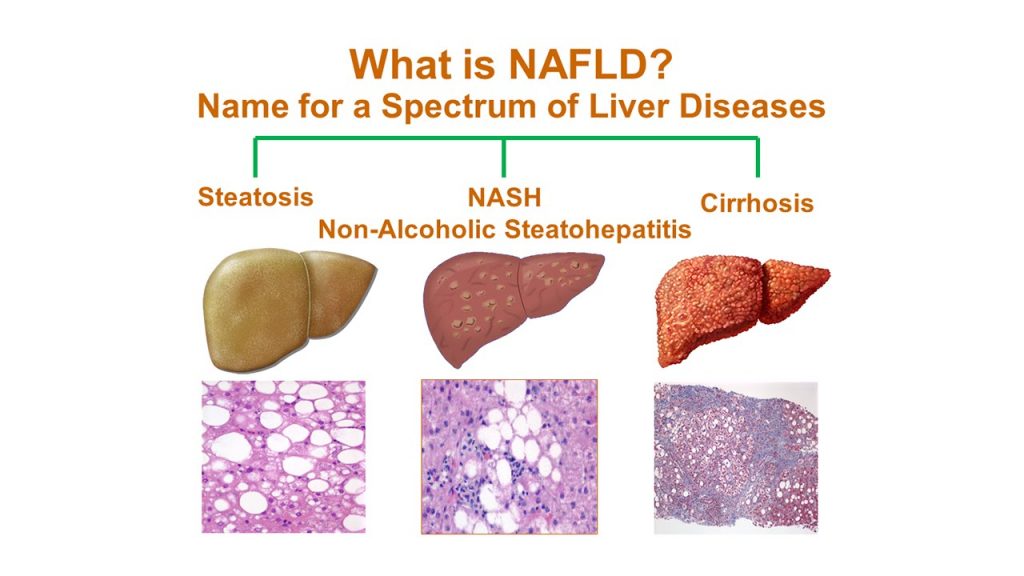Non Alcoholic Fatty Liver Disease 