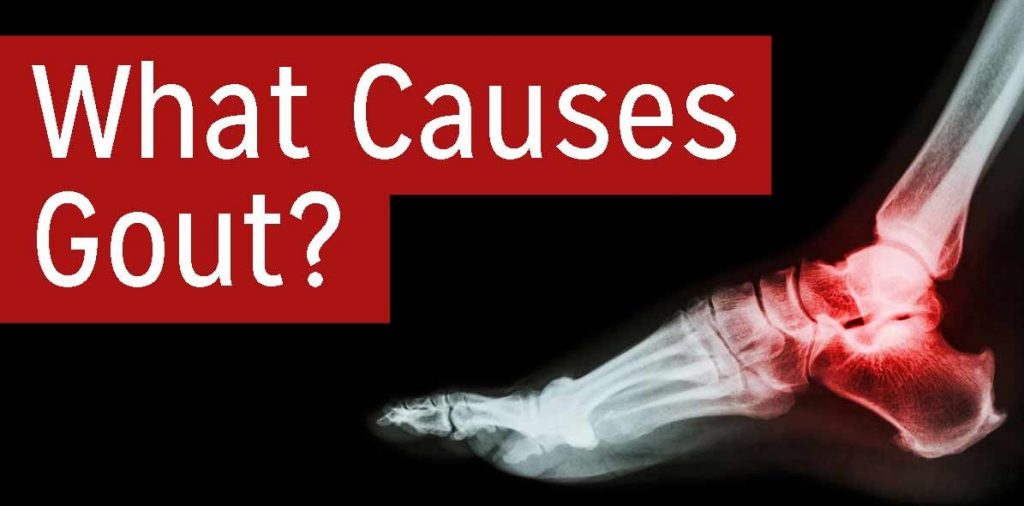 What Are The Causes of Gout